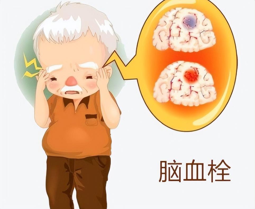 最新治療腦血栓方法解析，告別血栓困擾，重拾健康生活，揭秘最新腦血栓治療方案，重獲健康生活新篇章