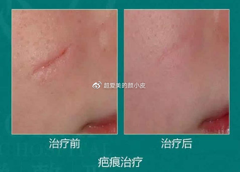 凹陷疤痕最新激光治療，高效突破，凹陷疤痕激光治療新篇章